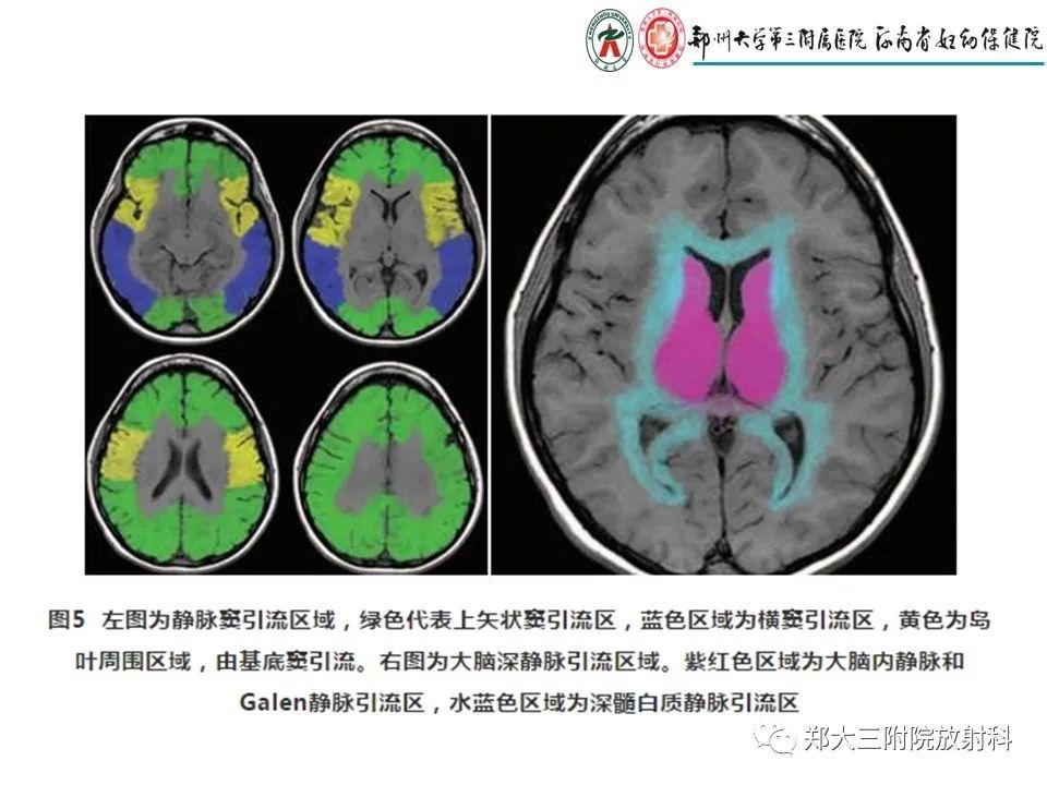 【PPT】静脉窦血栓的影像诊断及误区