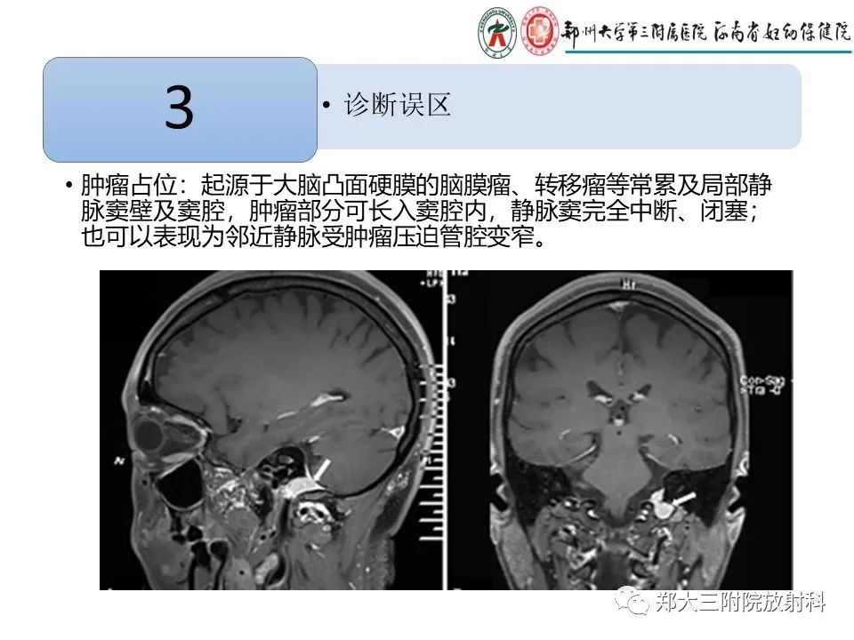 【PPT】静脉窦血栓的影像诊断及误区
