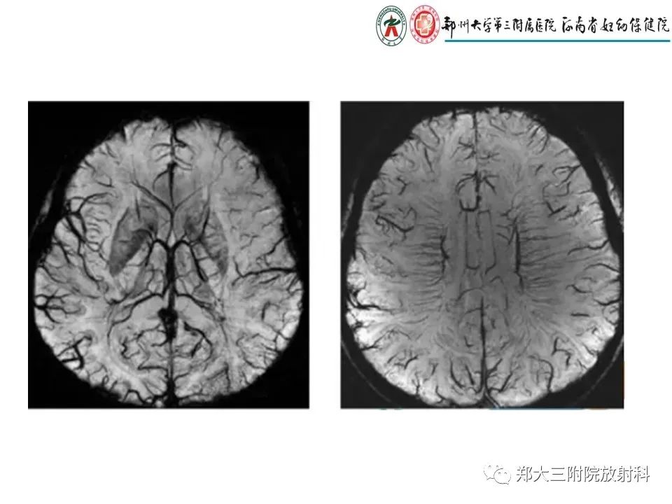 【PPT】静脉窦血栓的影像诊断及误区