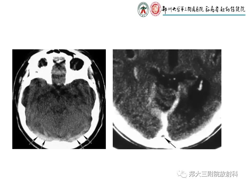 【PPT】静脉窦血栓的影像诊断及误区