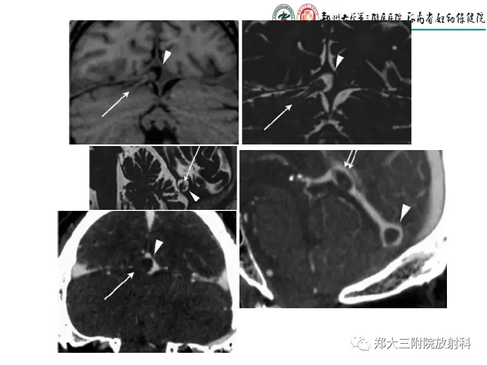 【PPT】静脉窦血栓的影像诊断及误区