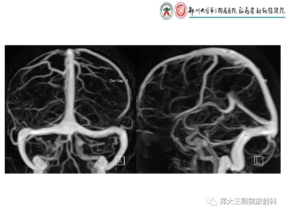 【PPT】静脉窦血栓的影像诊断及误区