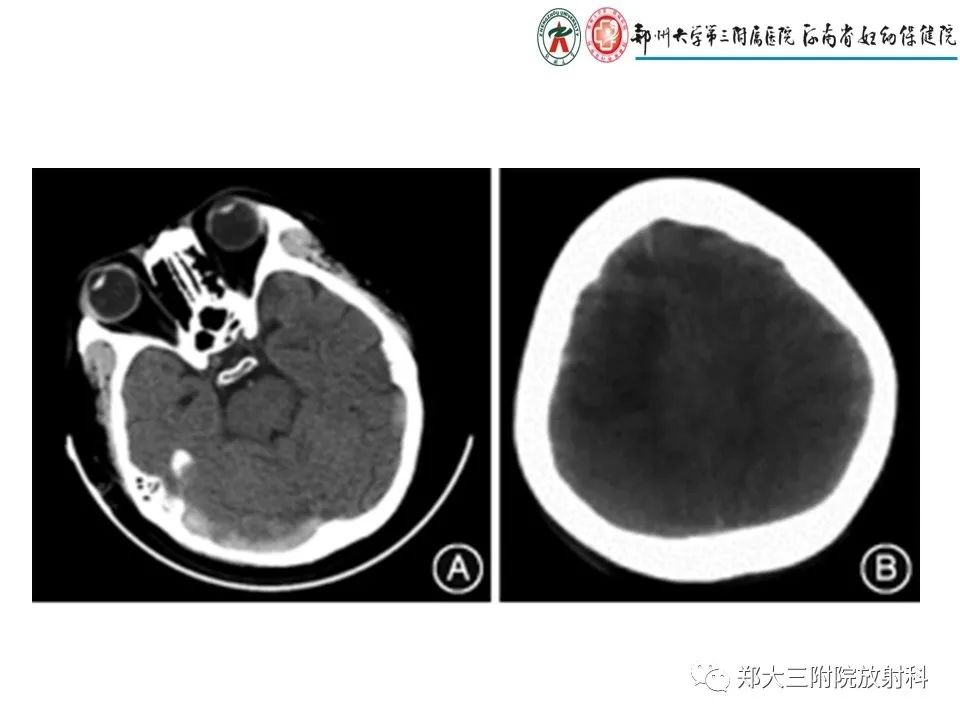 【PPT】静脉窦血栓的影像诊断及误区
