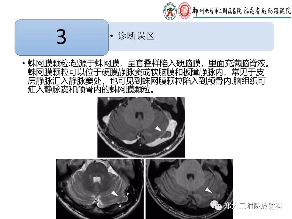 【PPT】静脉窦血栓的影像诊断及误区