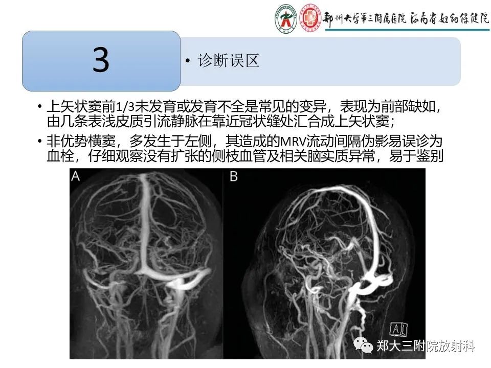 【PPT】静脉窦血栓的影像诊断及误区
