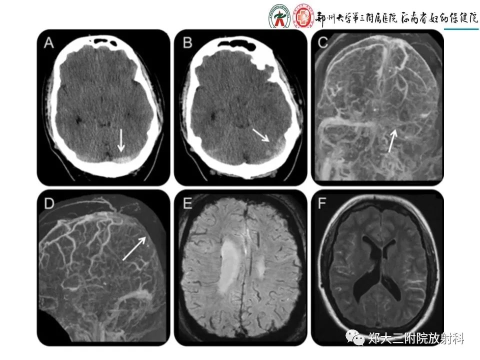 【PPT】静脉窦血栓的影像诊断及误区