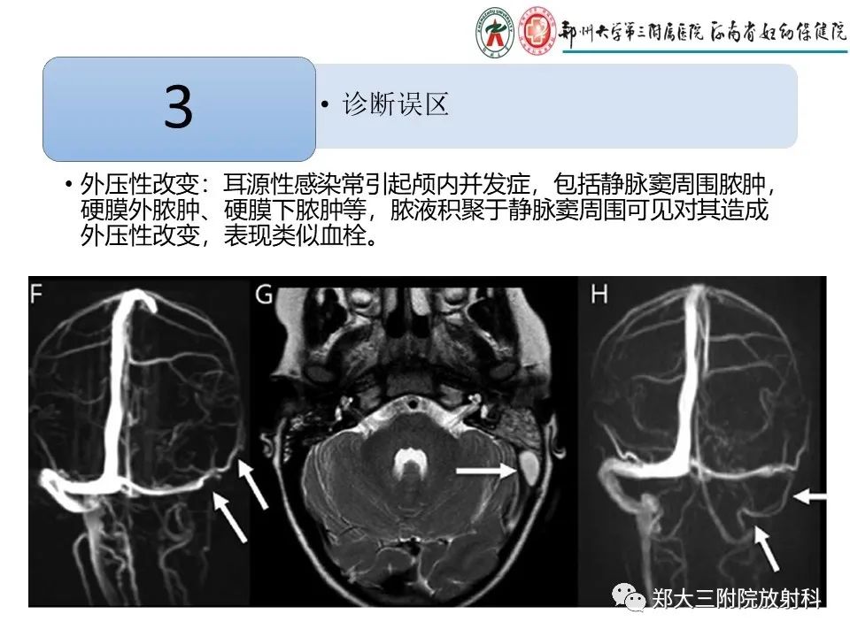 【PPT】静脉窦血栓的影像诊断及误区