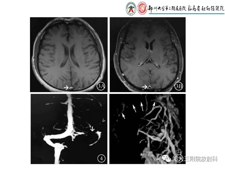 【PPT】静脉窦血栓的影像诊断及误区
