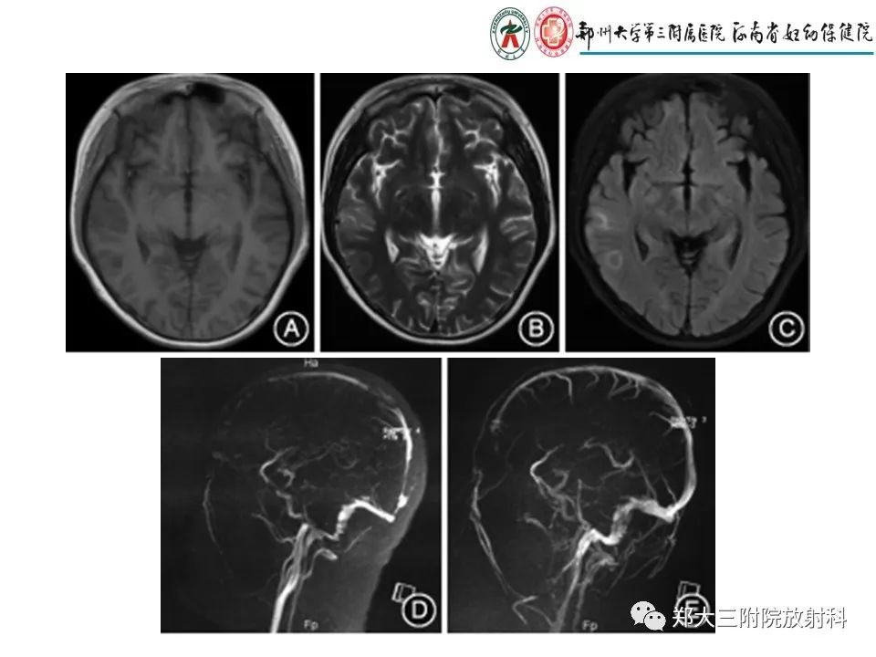 【PPT】静脉窦血栓的影像诊断及误区