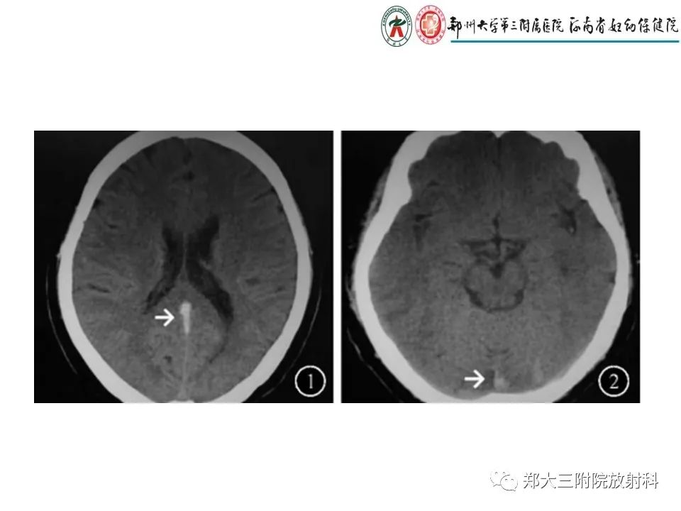 【PPT】静脉窦血栓的影像诊断及误区