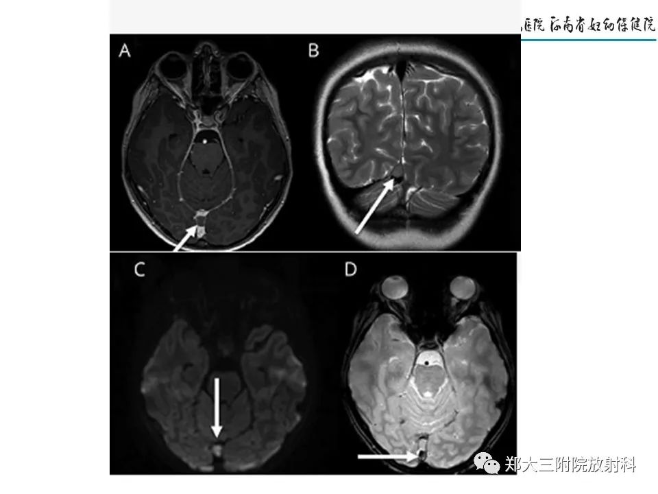 【PPT】静脉窦血栓的影像诊断及误区