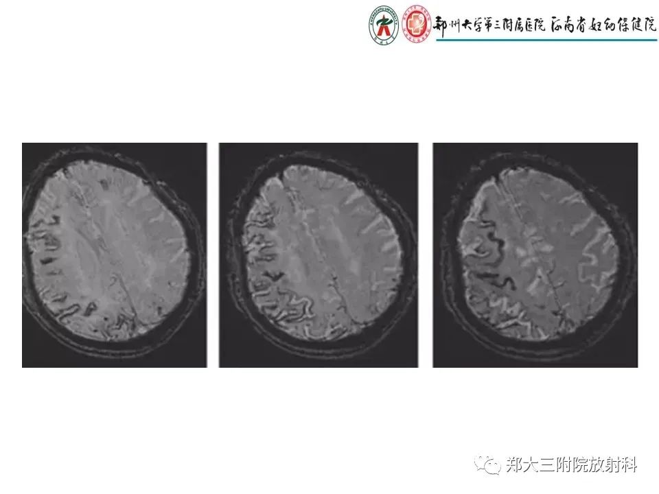 【PPT】静脉窦血栓的影像诊断及误区