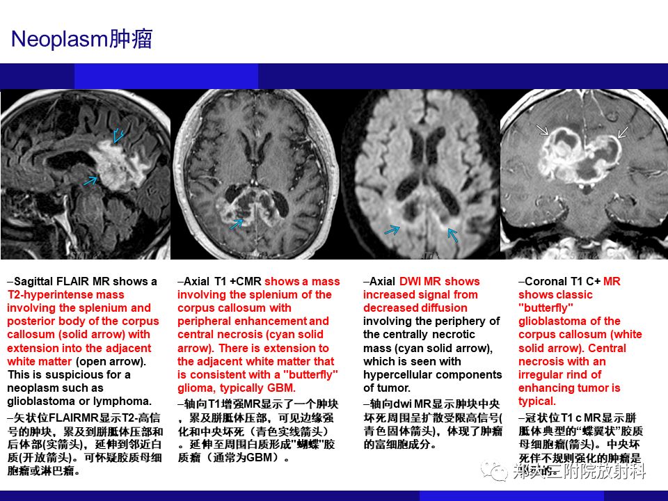 【PPT】胼胝体异常病变的鉴别