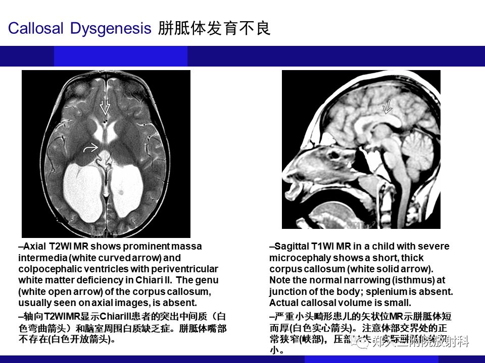 【PPT】胼胝体异常病变的鉴别