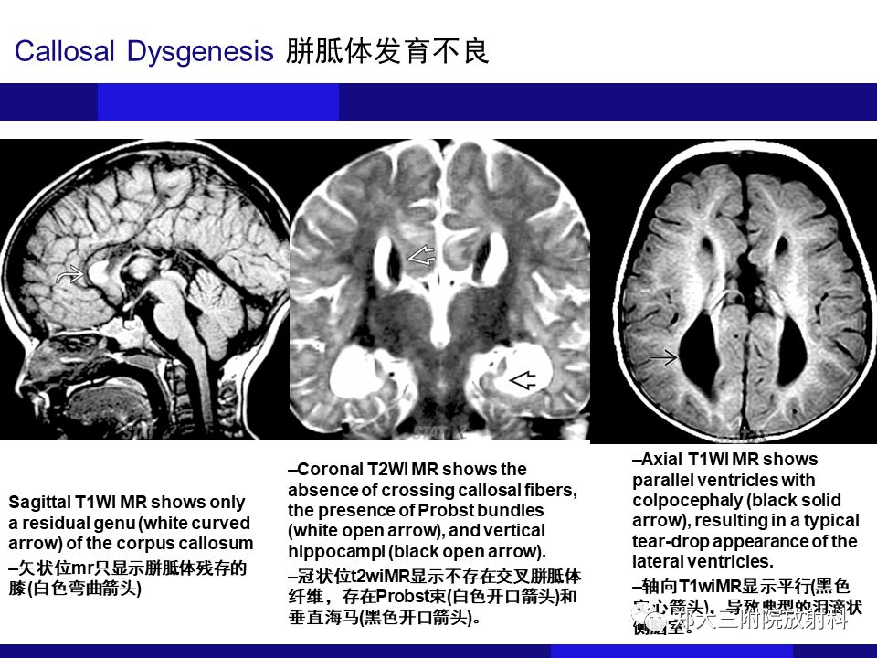 【PPT】胼胝体异常病变的鉴别