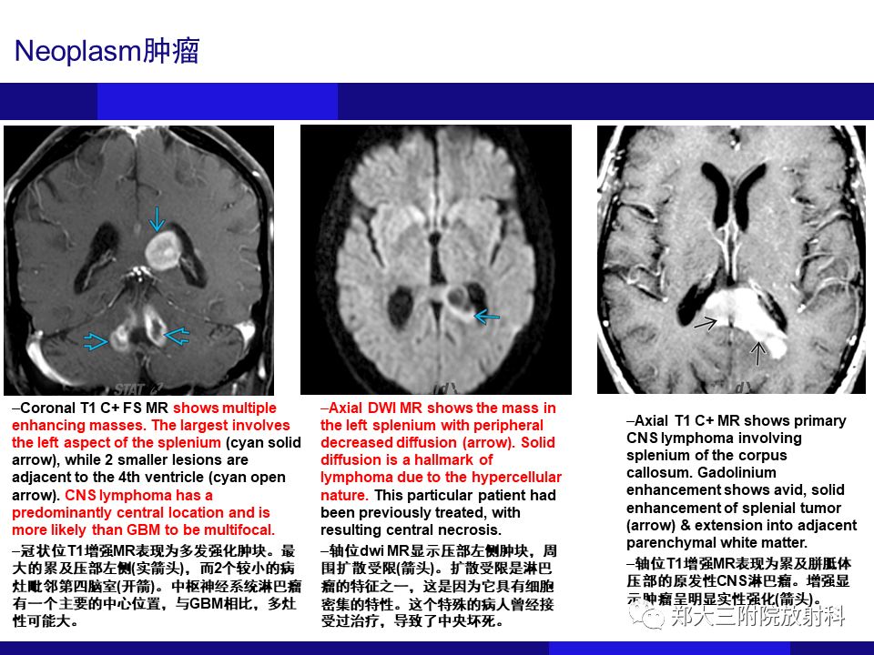 【PPT】胼胝体异常病变的鉴别