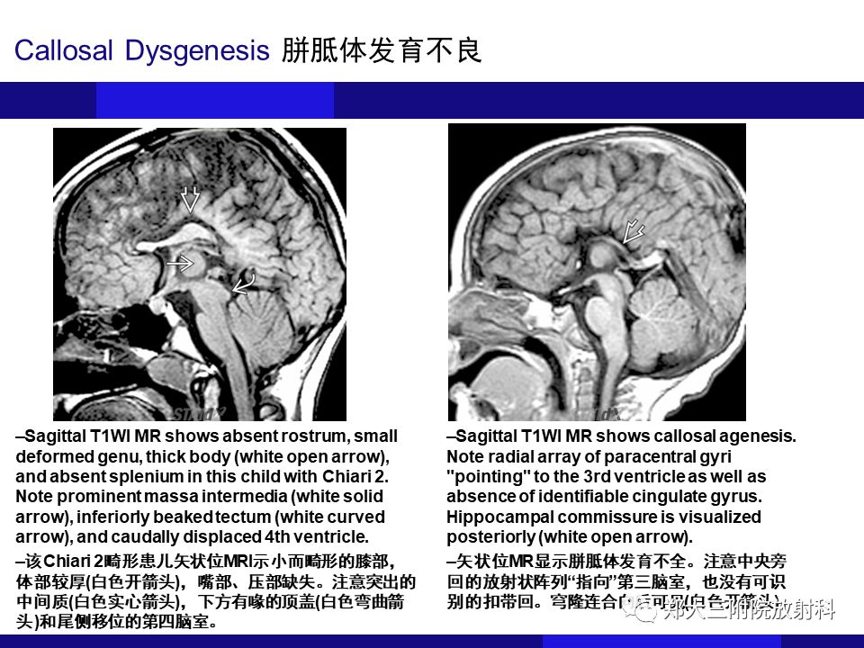【PPT】胼胝体异常病变的鉴别