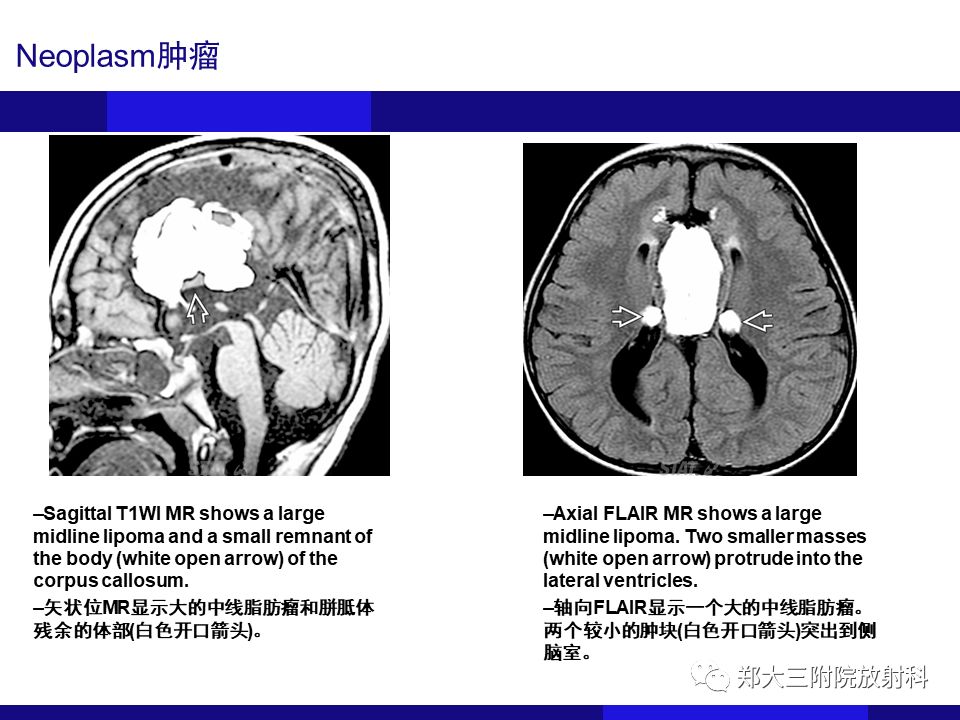 【PPT】胼胝体异常病变的鉴别