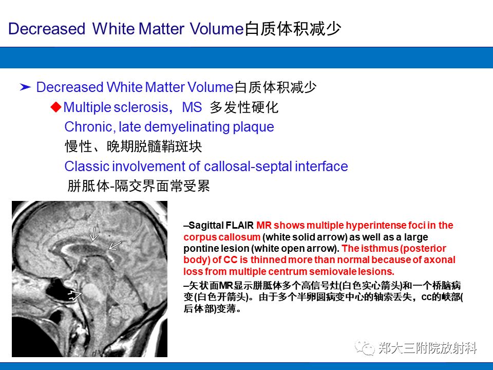【PPT】胼胝体异常病变的鉴别