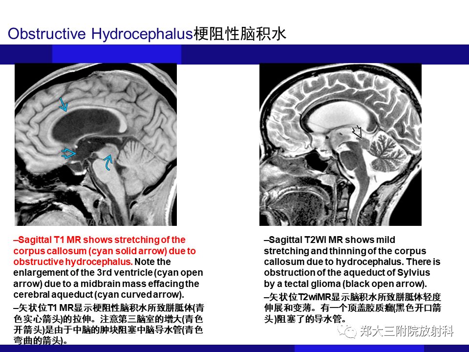 【PPT】胼胝体异常病变的鉴别