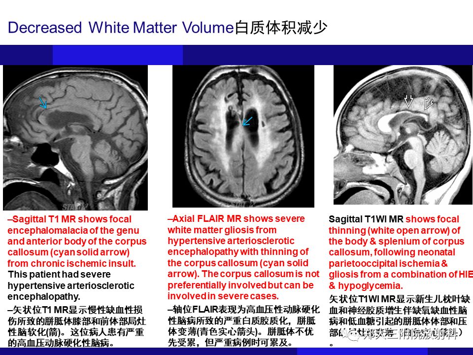 【PPT】胼胝体异常病变的鉴别