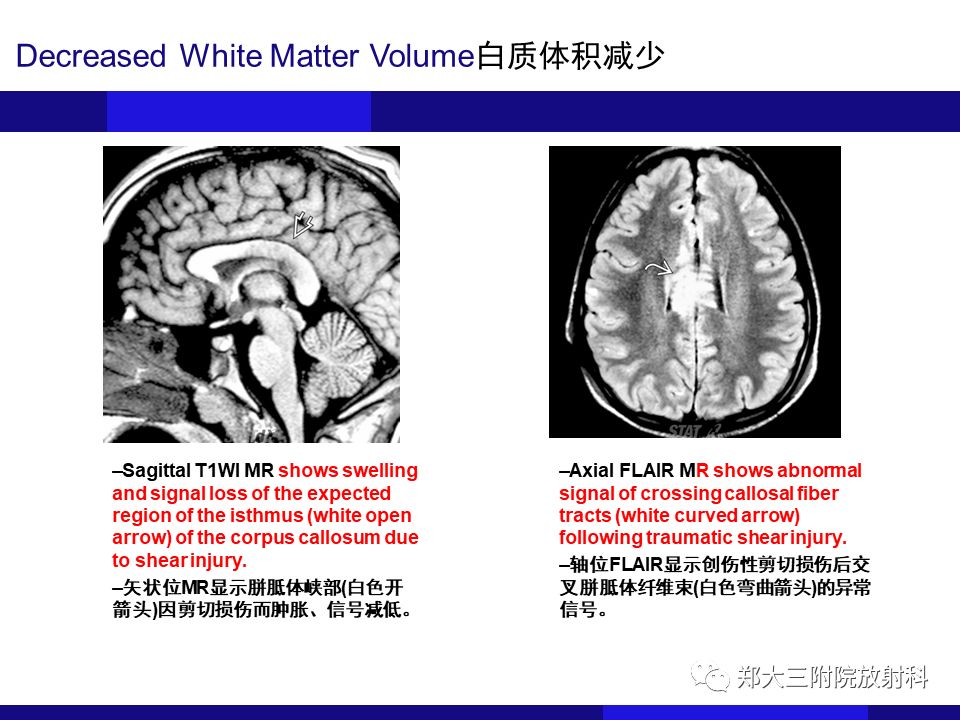 【PPT】胼胝体异常病变的鉴别