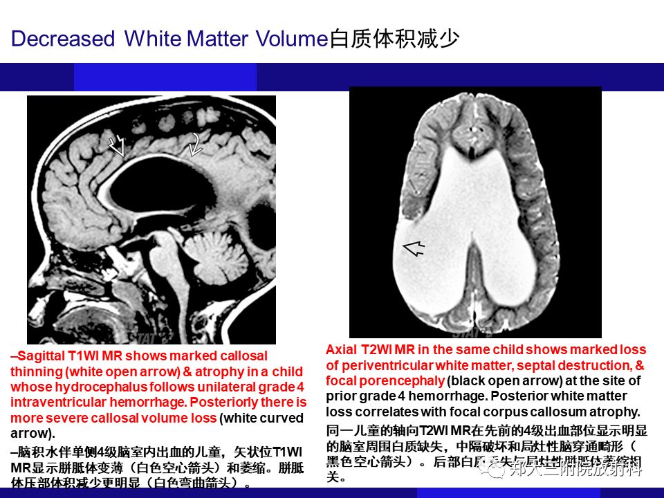 【PPT】胼胝体异常病变的鉴别