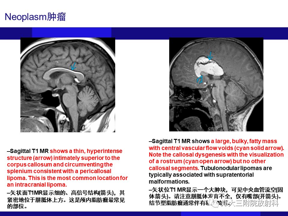 【PPT】胼胝体异常病变的鉴别
