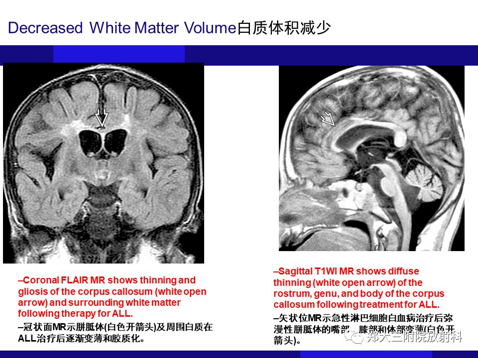 【PPT】胼胝体异常病变的鉴别