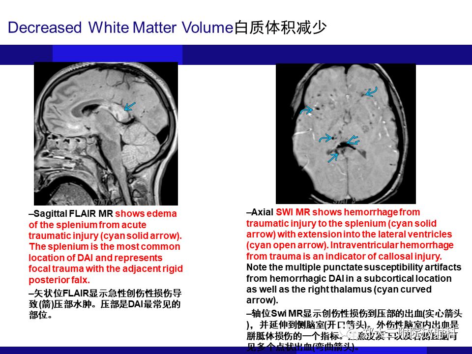 【PPT】胼胝体异常病变的鉴别