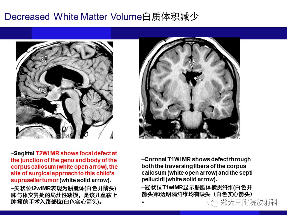 【PPT】胼胝体异常病变的鉴别