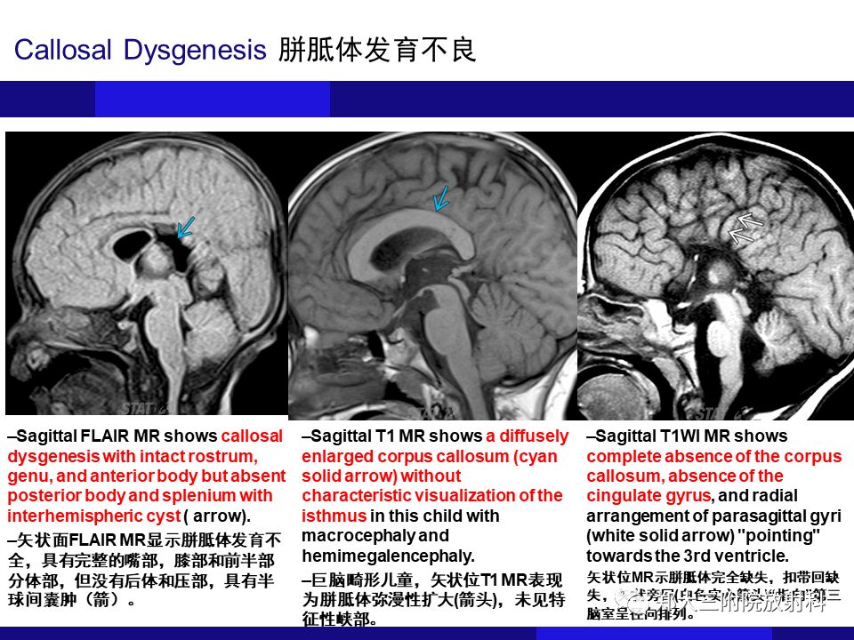 【PPT】胼胝体异常病变的鉴别