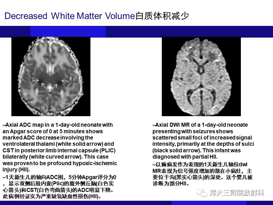【PPT】胼胝体异常病变的鉴别