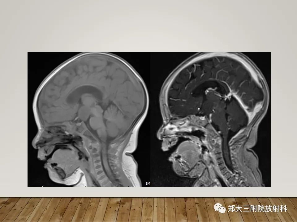 【PPT】灰结节错构瘤的影像诊断