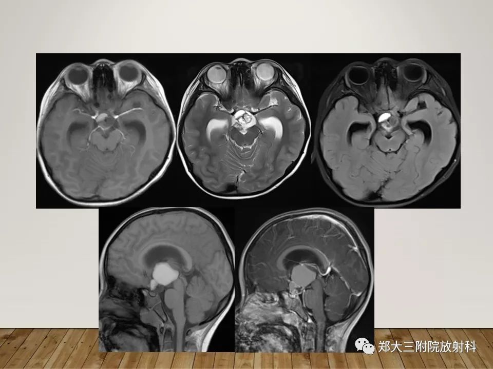 【PPT】灰结节错构瘤的影像诊断