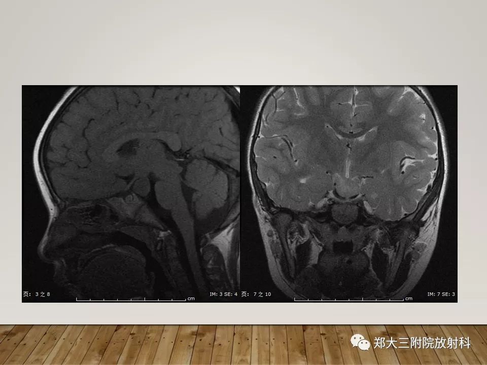 【PPT】灰结节错构瘤的影像诊断