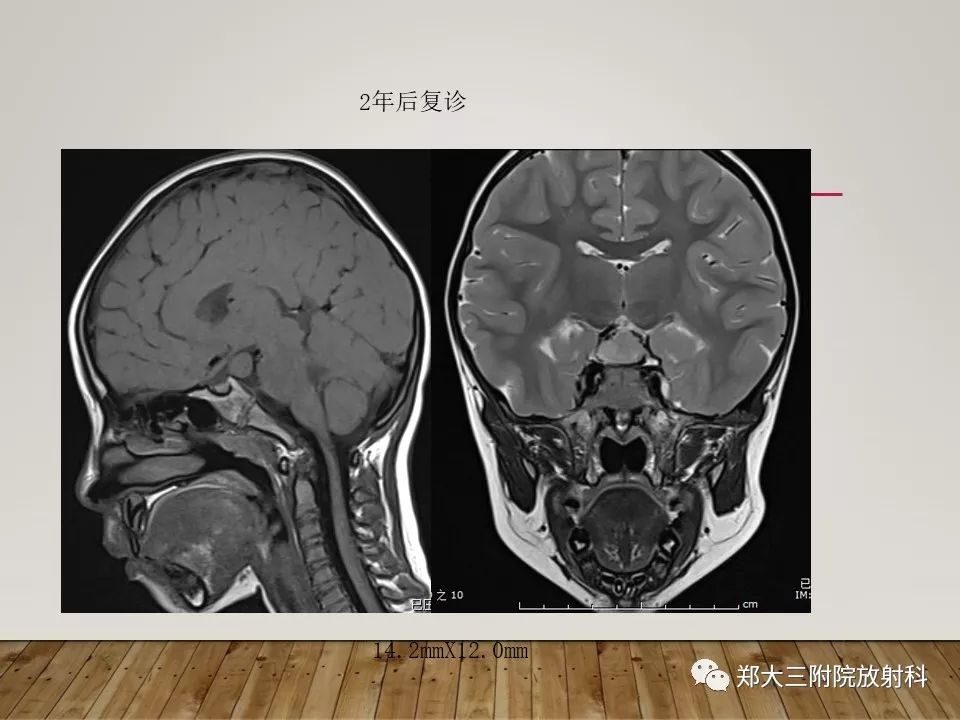 【PPT】灰结节错构瘤的影像诊断