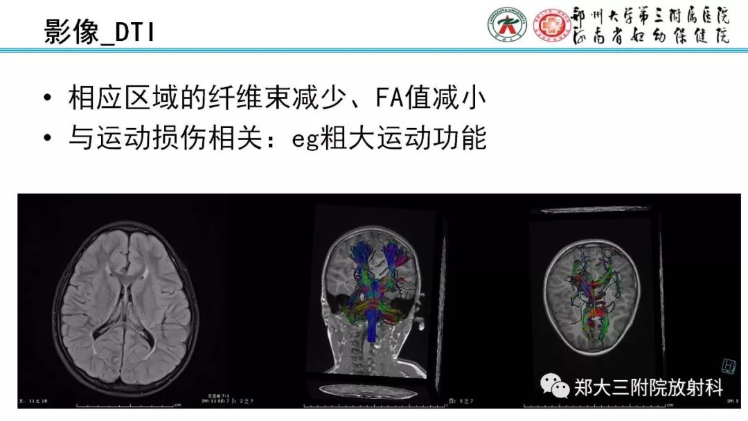 【PPT】PVL脑室周围白质软化症的影像表现