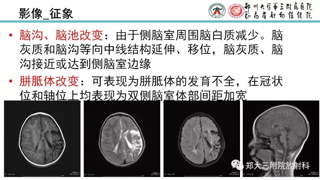 【PPT】PVL脑室周围白质软化症的影像表现