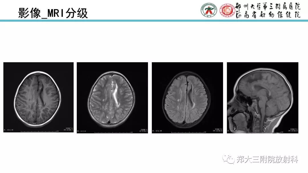 【PPT】PVL脑室周围白质软化症的影像表现