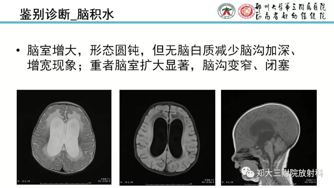 【PPT】PVL脑室周围白质软化症的影像表现