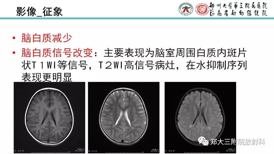 【PPT】PVL脑室周围白质软化症的影像表现