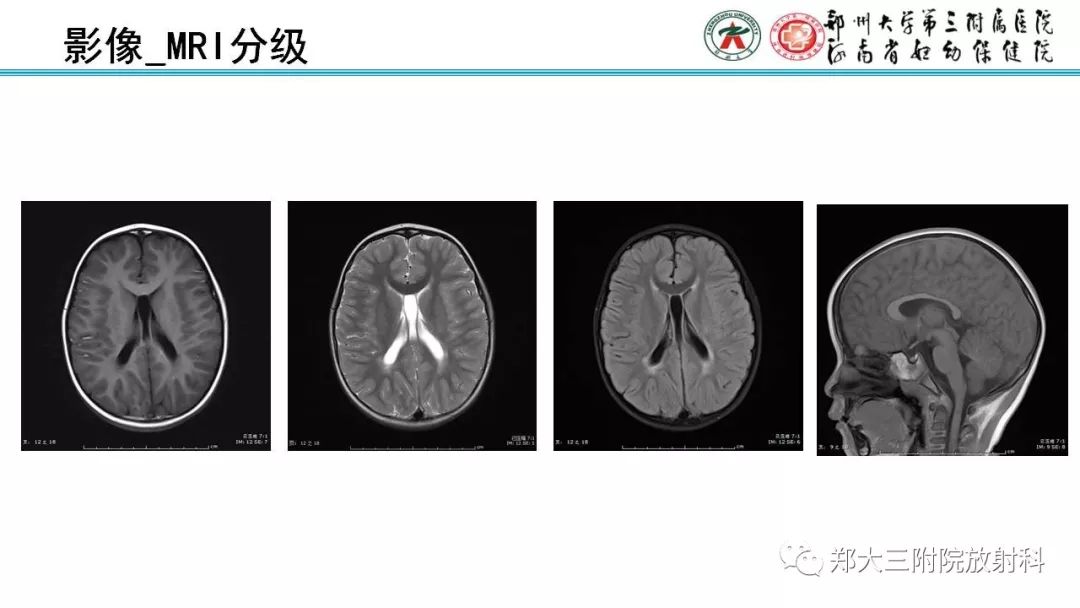【PPT】PVL脑室周围白质软化症的影像表现