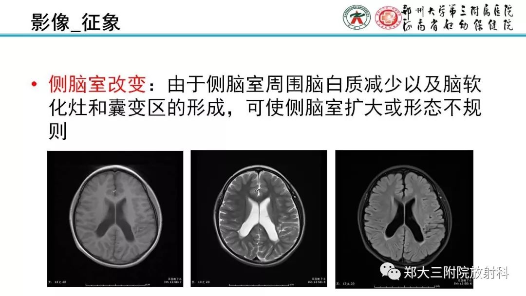 【PPT】PVL脑室周围白质软化症的影像表现