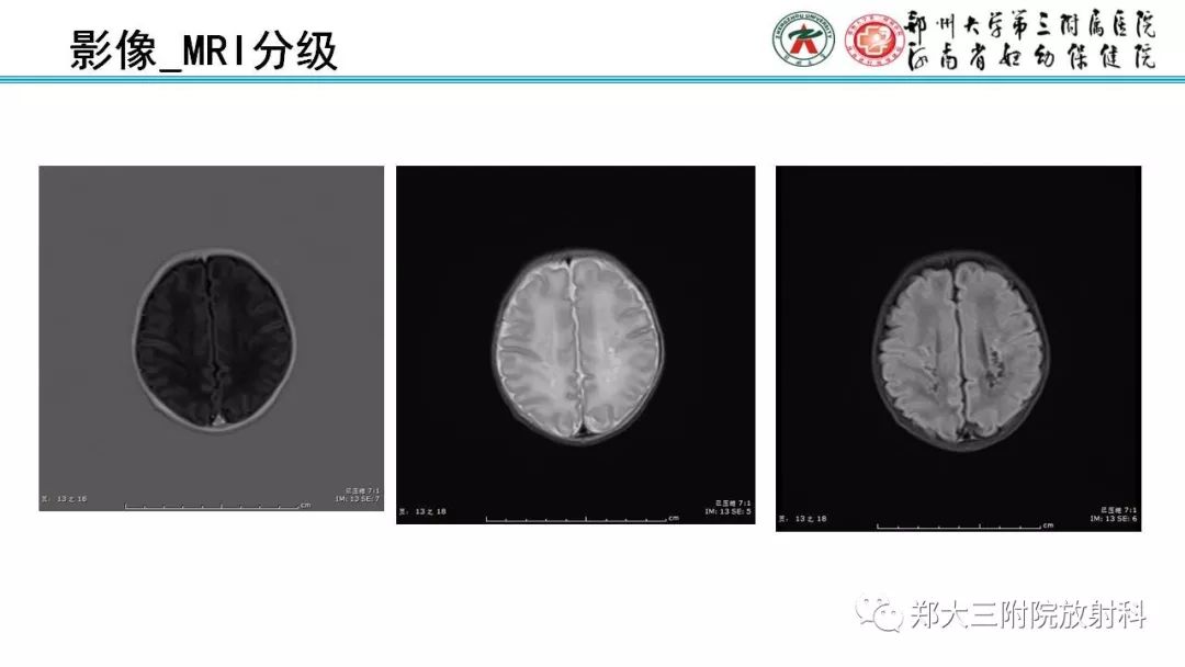 【PPT】PVL脑室周围白质软化症的影像表现
