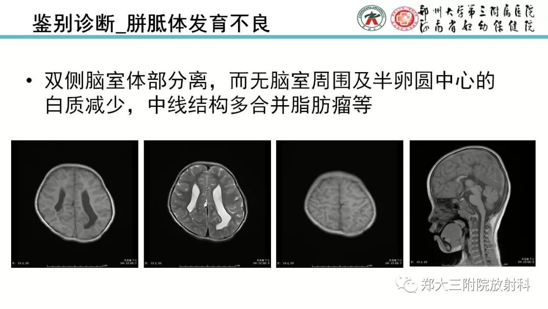 【PPT】PVL脑室周围白质软化症的影像表现
