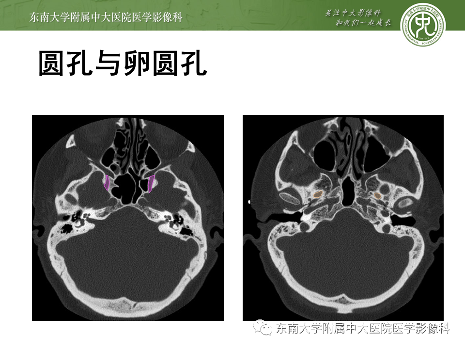 【PPT】颅神经原发肿瘤