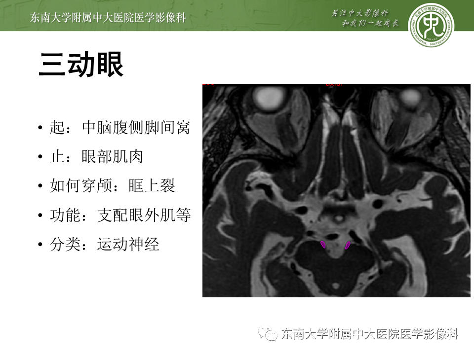 【PPT】颅神经原发肿瘤