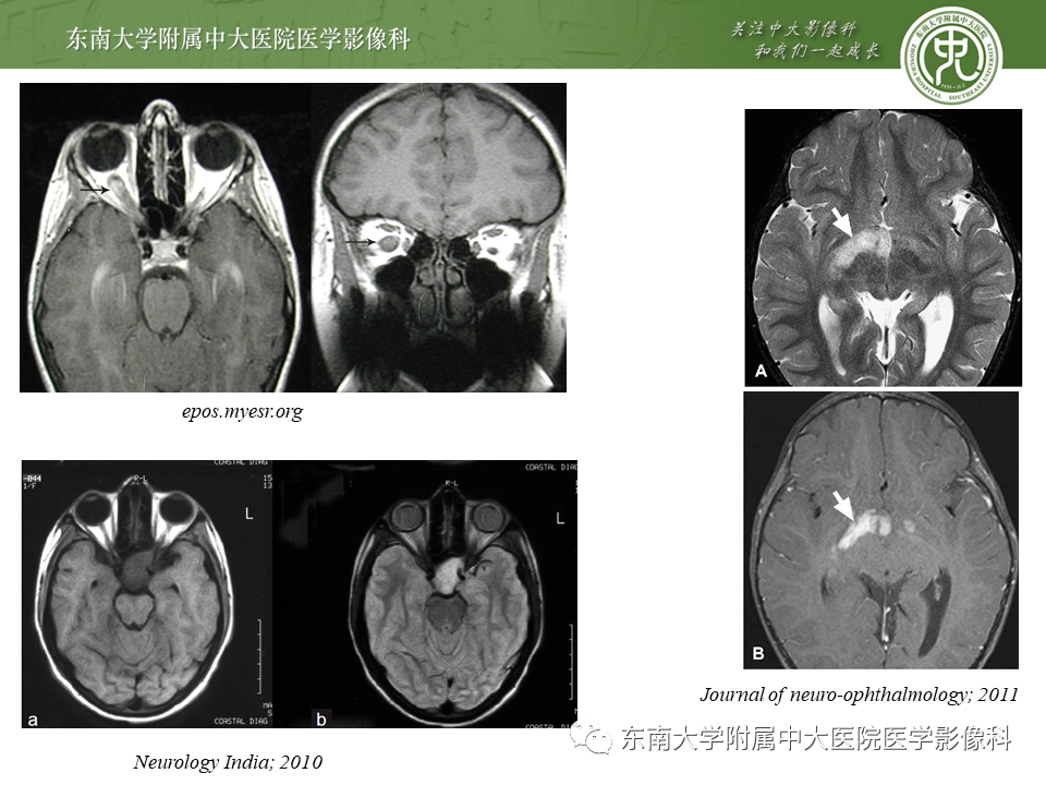 【PPT】颅神经原发肿瘤