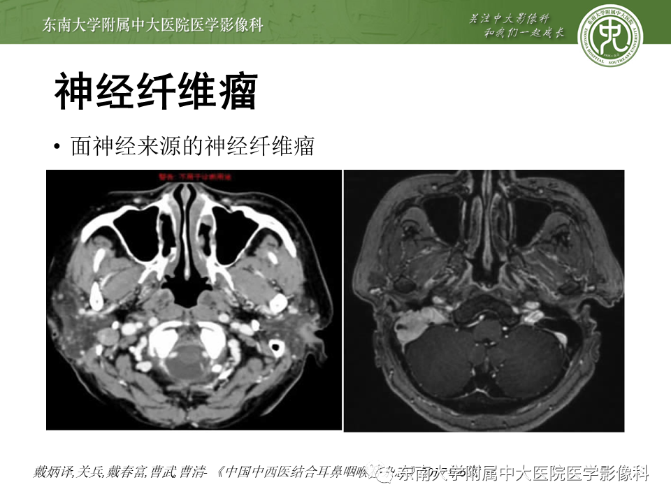 【PPT】颅神经原发肿瘤